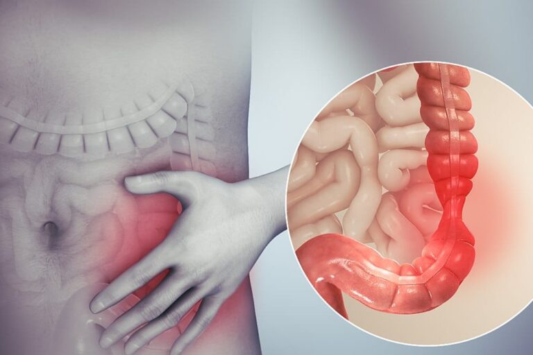 1200px-Irritable_bowel_syndrome IBS
