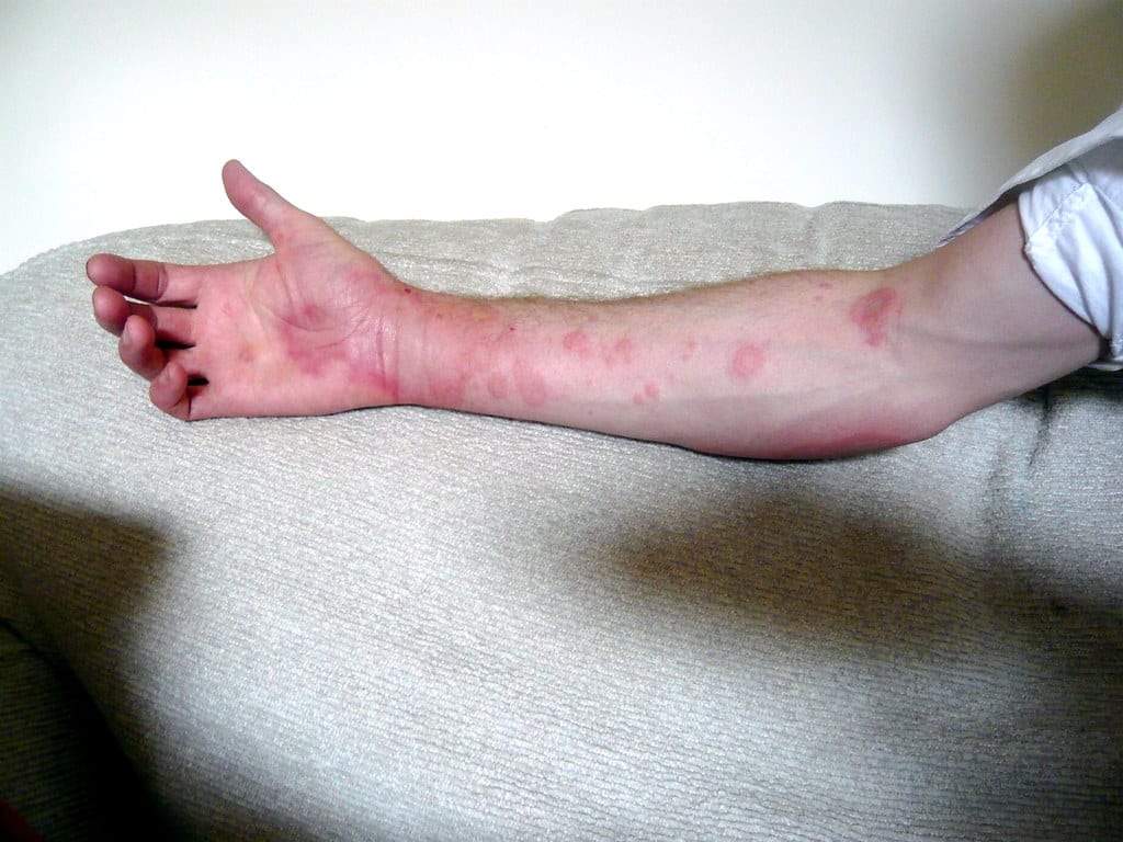 Urticaria (Chronic Hives)