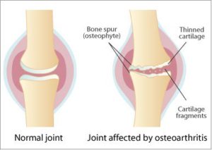 Arthritis In Your Hands