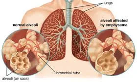 Cause and Prevention COPD