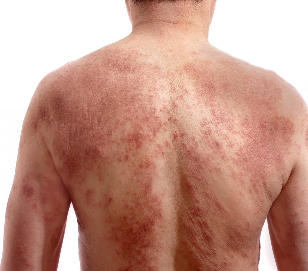Eczema or Atopic Dermatitis