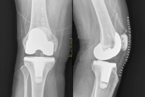Hip and Knee Replacement Surgery