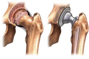 Hip and Knee Replacement Surgery