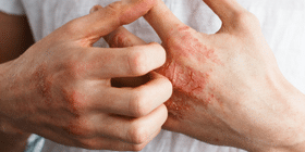 Psoriatic Arthritis Symptoms Causes + Self-Management Psoriatic Arthritis Symptoms Causes + Self-Management, psoriasis