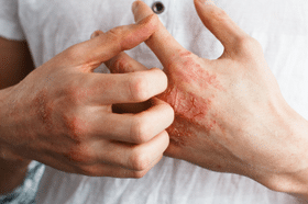 Psoriatic Arthritis Symptoms Causes + Self-Management Psoriatic Arthritis Symptoms Causes + Self-Management, psoriasis