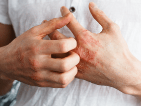 Psoriatic Arthritis Symptoms Causes + Self-Management