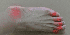 Risks, Symptoms, Treatments,& Foods to Avoid for Gout