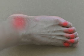 Risks, Symptoms, Treatments,& Foods to Avoid for Gout Risks, Symptoms, Treatments,& Foods to Avoid for Gout