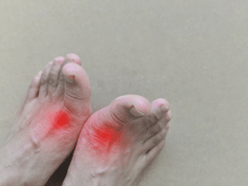 Risks, Symptoms, Treatments,& Foods to Avoid for Gout