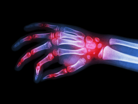 Seropositive vs. Seronegative Rheumatoid Arthritis 