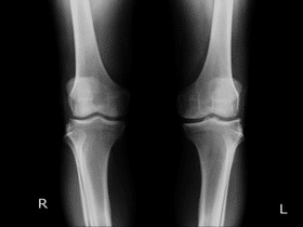 What Is Osteoarthritis?