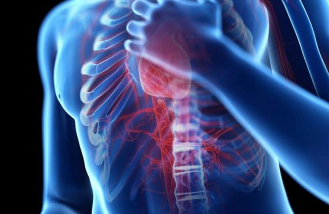 Illustration of a man with chest pain hypertriglyceridemia