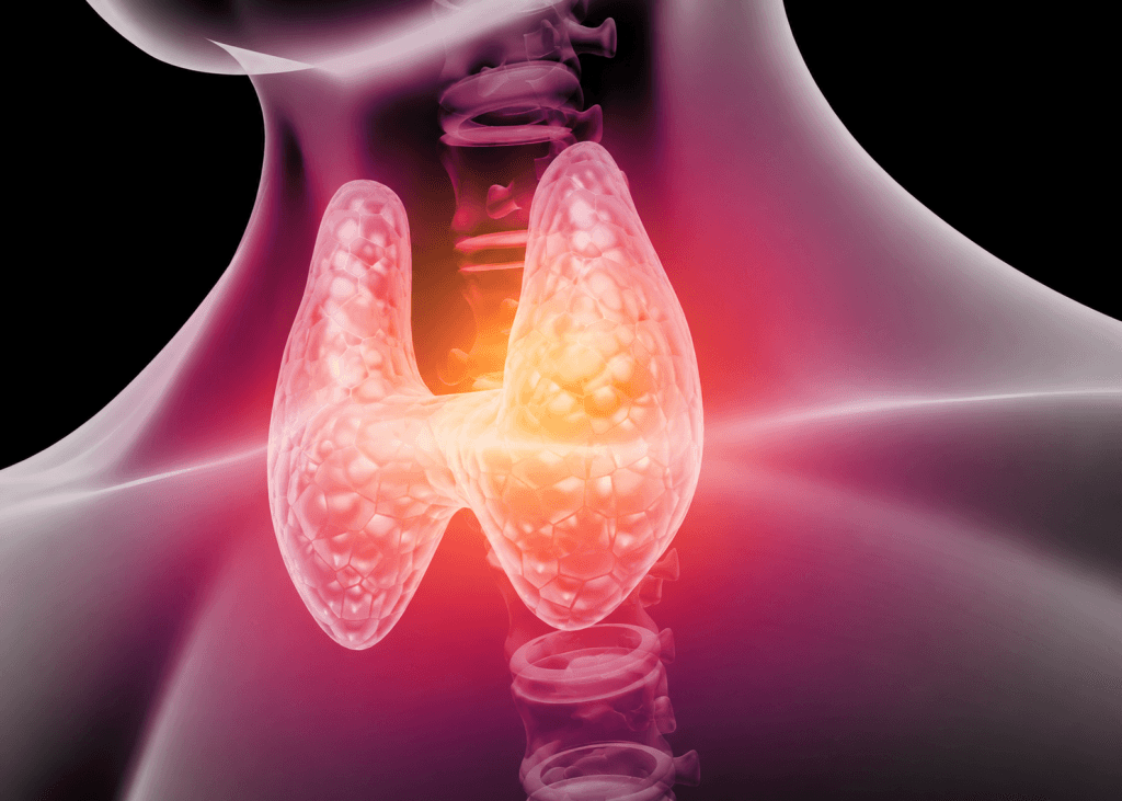 Grave's disease